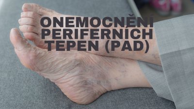 Ochorenie periférnych tepien (PAD): Prvé kroky na prevenciu a starostlivosť o vaše nohy | ARNO-obuv.sk - obuv s tradíciou